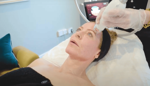 woman lying on couch having radiofrequency microneedling treatment