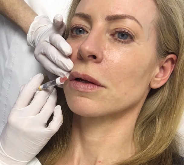 Alice Hart-Davis having lip filler treatment 